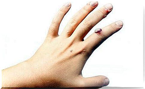 nail polish can make warts disappear