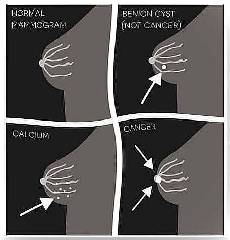 Scheme of benign or malignant breast calcifications. 