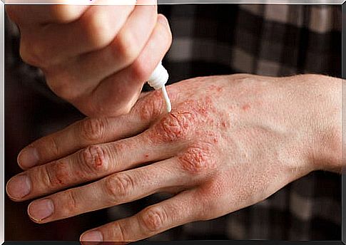 Treatment of psoriasis with an emolient