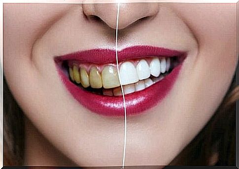 Activated charcoal does not make teeth white