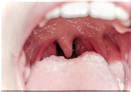 Uvilitis or inflammation of the uvula.
